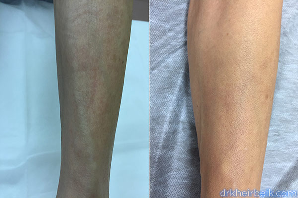 Varicose veins of the arms