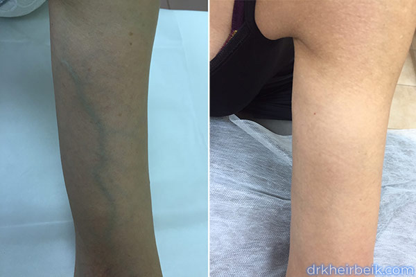 Varicose veins of the arms