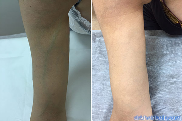 Varicose veins of the arms