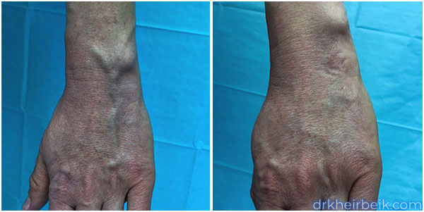 Varicose veins of the arms