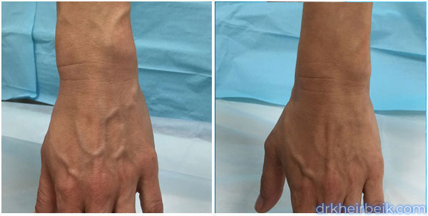 Varicose veins of the arms