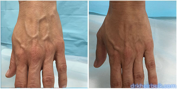 Varicose veins of the arms